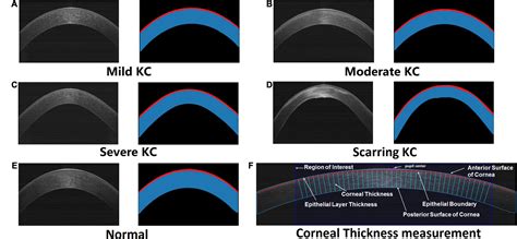 measuring corneal thickness|how to increase corneal thickness.